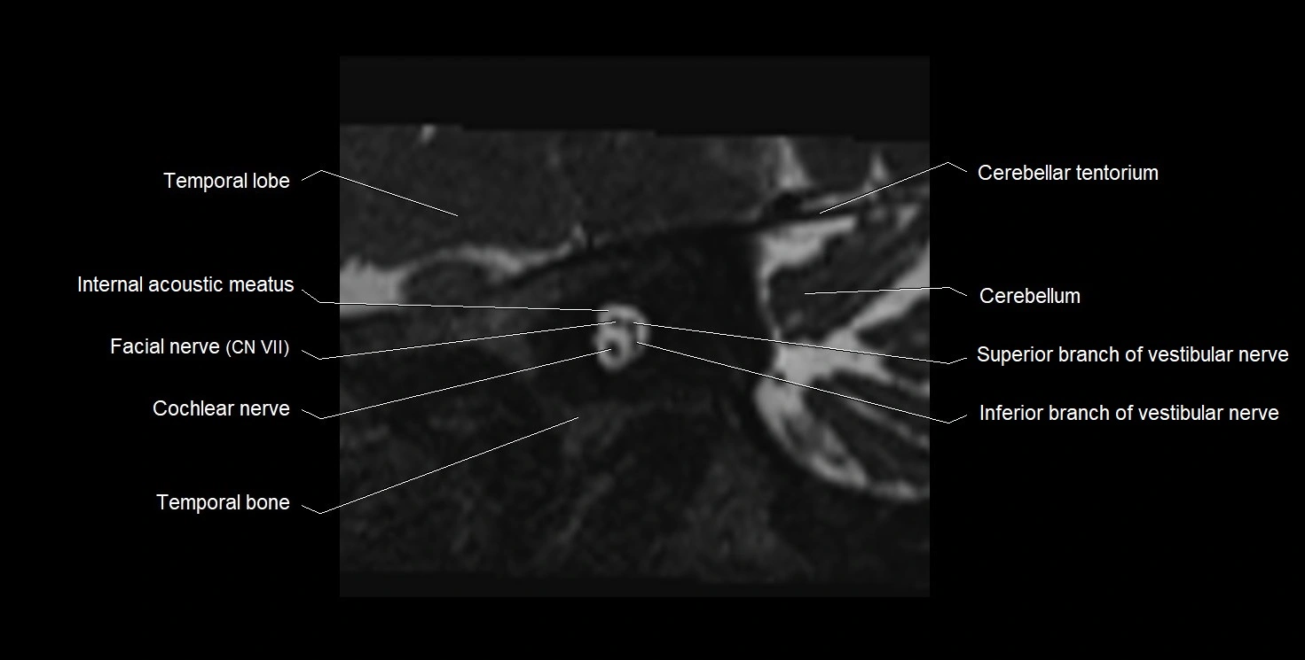 Internal auditory meatus (IAM) 3T sagittal cross sectional anatomy image 15.webp